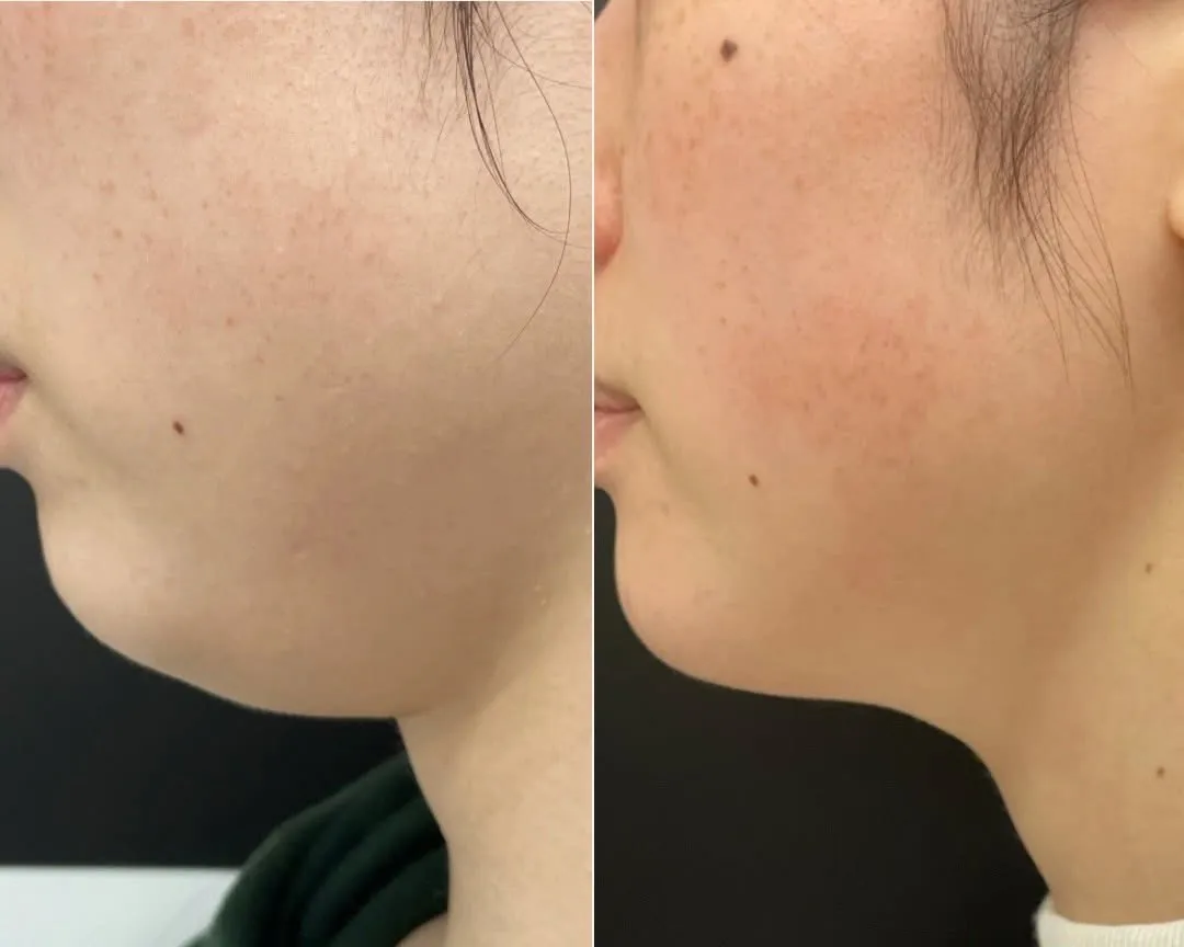 話題の【脂肪分解剤レモンボトル】導入しました👏